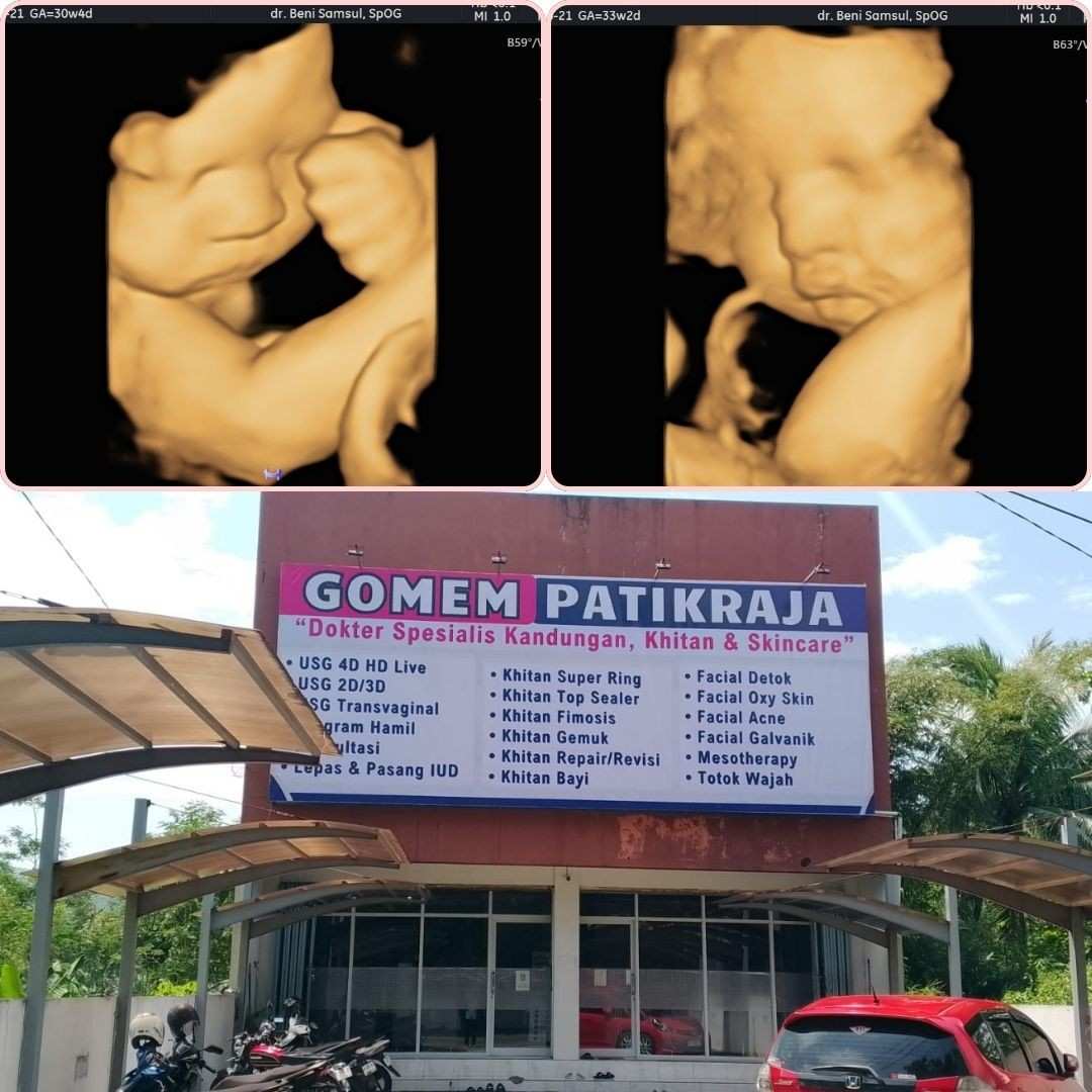 Lepas KB IUD Tanpa Takut sekitar Karanglewas