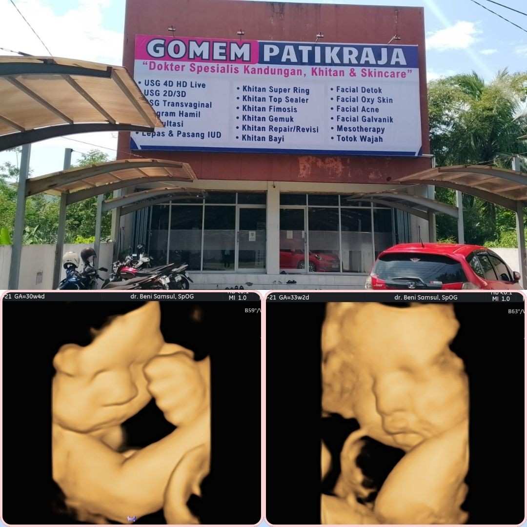 Pasang KB IUD dekat Jatilawang yang Nyaman