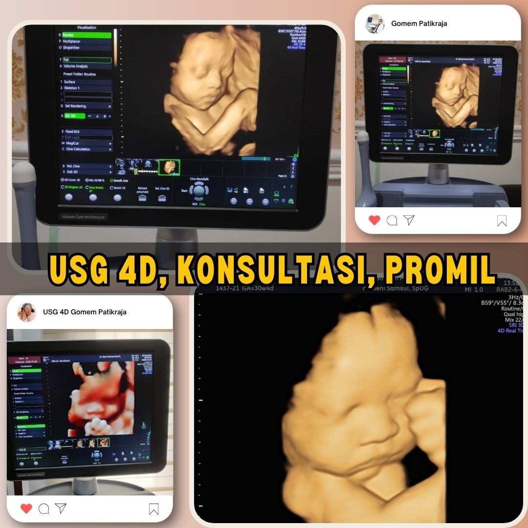 Tempat Pasang IUD sekitar Rawalo yang Bikin Tenang
